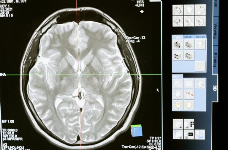 How Weed Affects Your Memory: Short-Term Effects and Long-Term Damage